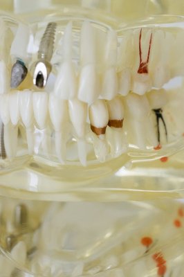 �Cu�nto tiempo dura el proceso de colocaci�n de un implante dental?